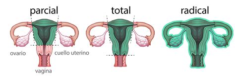 histerectomía abdominal - cavidad abdominal